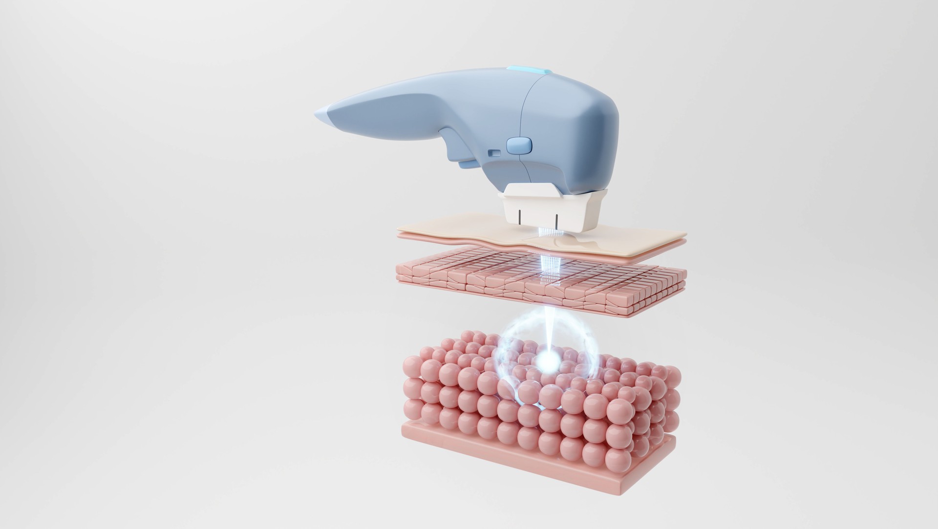 HIFU laser targets SMAS through skin layers